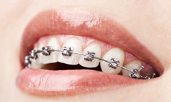 metal braces